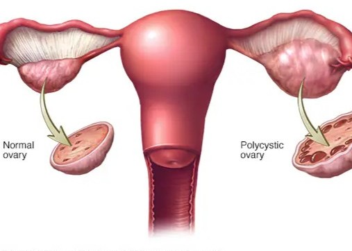 Polycystic Ovarian Syndrome (PCOS)